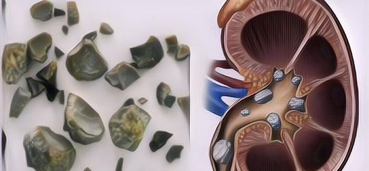 9 Cara Mencegah Penyakit Batu Ginjal, Kuncinya Ada di Pola Makan dan Hidup Sehat