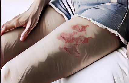 Mengenal Apa Itu Herpes Zoster: Gejala, Penyebab, dan Cara Mengobati