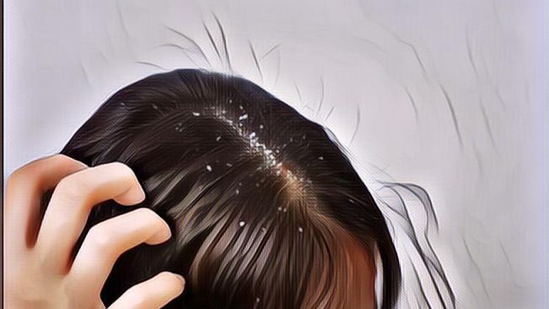 7 Cara Atasi Masalah Ketombe Membandel dengan Alami