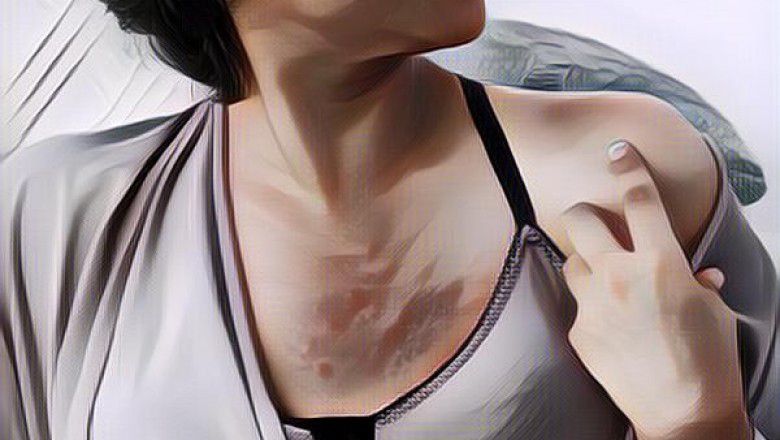 Angka Pengidap Kanker Payudara di Indonesia Masih Tinggi, Bagaimana Cara Mengatasinya?