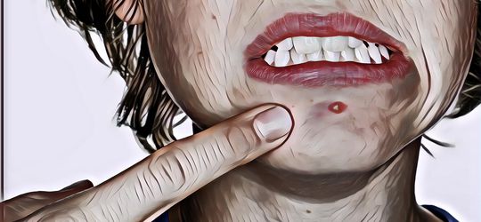 Bukan Cuma Skincare, Hati-Hati Mungkin Ini Penyebab Jerawatmu Makin Parah!