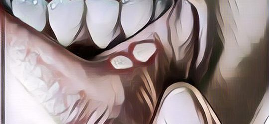 Cara Menyembuhkan Sariawan dengan Cepat, Alami tanpa Ada Efek Bahayanya