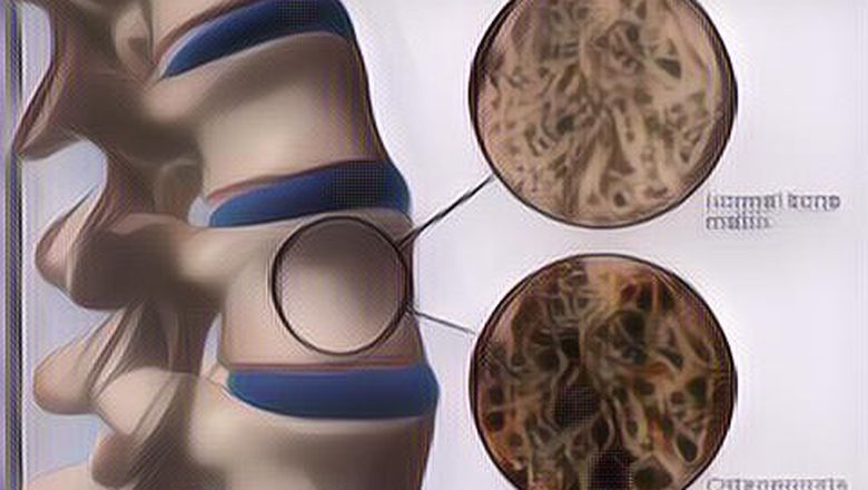 Wajib Tahu! 7 Kebiasaan Buruk Ini Bisa Merusak Tulang