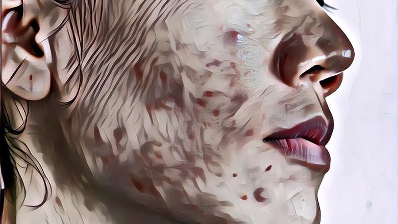 Jerawat Bandel Di Wajah Susah Ilang? Jangan-Jangan Kamu terlalu Banyak Memakan Ini