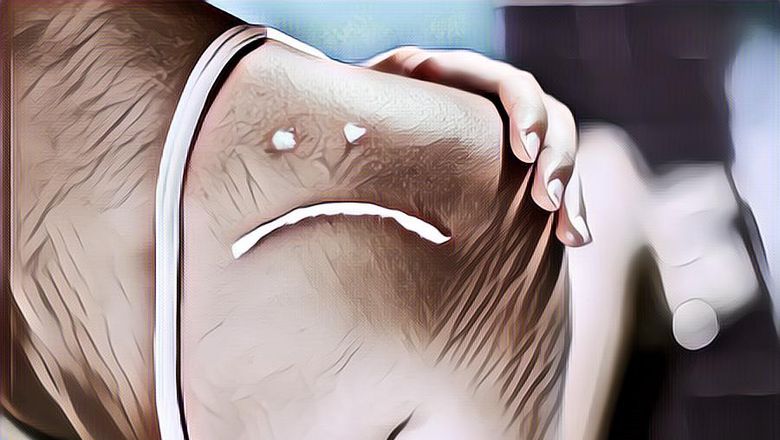 Jangan Dibiarkan, Begini Cara Mengatasi Sunburn Pada Kulit Secara Alami