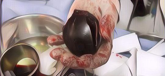 Ngeri! Bola Plastik Tersangkut Di Bokong Pria Ini, Tim Medis Lakukan Operasi 7 Jam Sampai Harus Pakai Bor Listrik