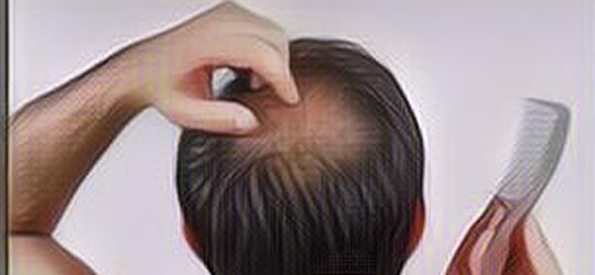 Masih Bisa Diusahakan, Coba 8 Cara Menumbuhkan Rambut dengan Natural Ini Jika Kamu Alami Kebotakan