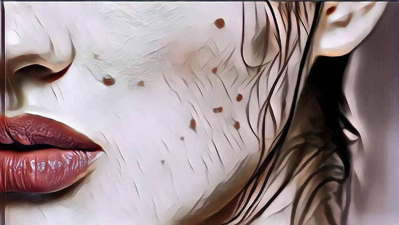 Perlukah Menghilangkan Tahi Lalat? Cek Faktanya Dulu, Yuk!