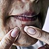Jerawat Hormon Kapan Bisa Hilang? Ini Kata Dokter