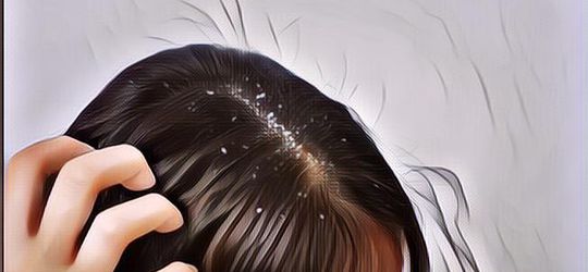 7 Cara Atasi Masalah Ketombe Membandel dengan Alami