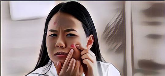 Begadang Jadi Picu Jerawat di Wajah: Apa Benar?