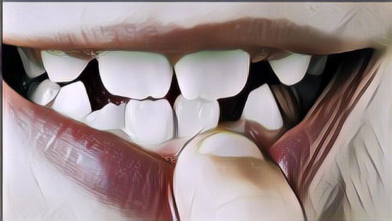 Punya Gigi Gingsul Manis, Dipertahankan atau Dicabut?