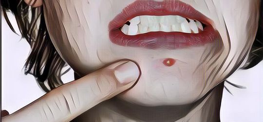 Efek Samping Produk Acnes, Awas! Bikin Jerawat Ilang