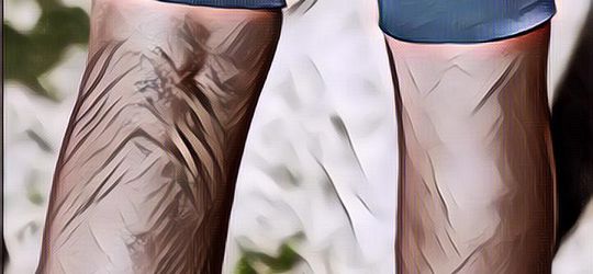 Begini Nih Gengs, Cara Efektif Hilangkan Varises Secara Alami, Mudah Kok!