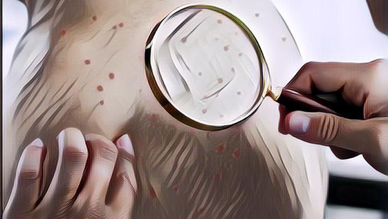 5 Cara Ini Ampuh Membersihkan Jerawat Punggung dengan Cepat!