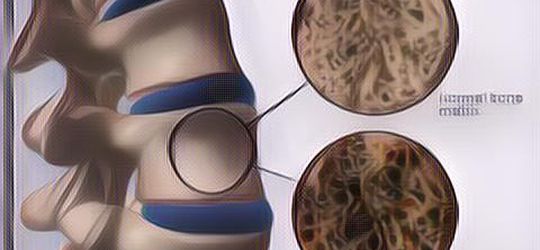 Wajib Tahu! 7 Kebiasaan Buruk Ini Bisa Merusak Tulang