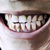 4 Bahan Natural yang Ampuh Menghilangkan Karang Gigimu, Gak Perlu ke Dokter Gigi!