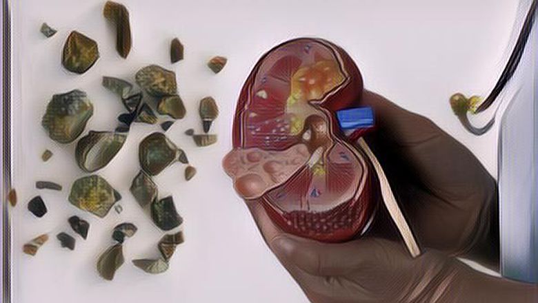 Bahaya dan Penyebab Batu Ginjal, Penyakit yang Menyerang Ashanty