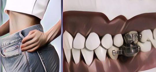 Unik Banget, Ada Alat Diet Magnet Yang Dipasang Ke Gigi Supaya Gak Makan Banyak