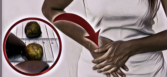 5 Cara Alami Sembuhkan Batu Empedu, Mau Coba?