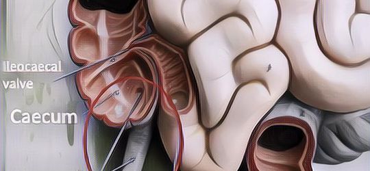 Cari Tahu Penyebab Penyakit Usus Buntu dan Cara Mencegahnya