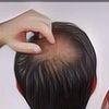 Masih Bisa Diusahakan, Coba 8 Cara Menumbuhkan Rambut dengan Natural Ini Jika Kamu Alami Kebotakan