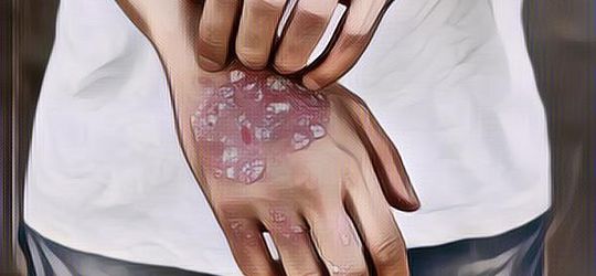 Apa Itu Psoriasis Vulgaris? Mengenal Lebih Dekat Masalah Kulit yang Sering Diabaikan