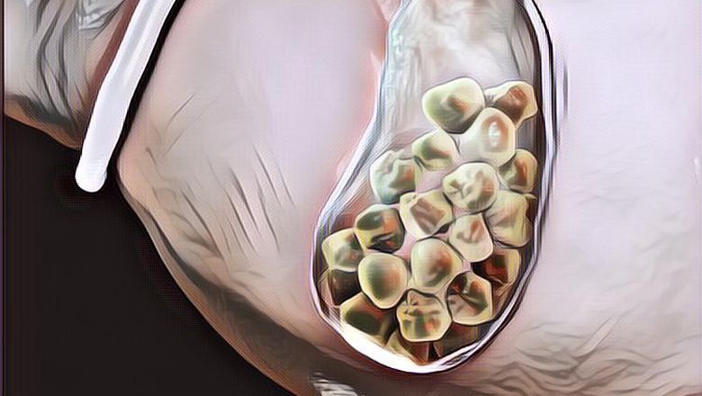 5 Cara Menyembuhkan Batu Empedu dengan Alami, Bisa Lebih Murah