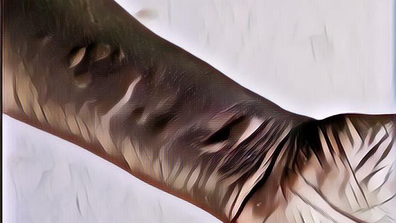 Intip Tips Atasi Alergi Dingin di Musim Hujan Ini