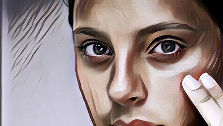Bikin Makin Cantik, Begini Cara Mengatasi Area Mata Gelap