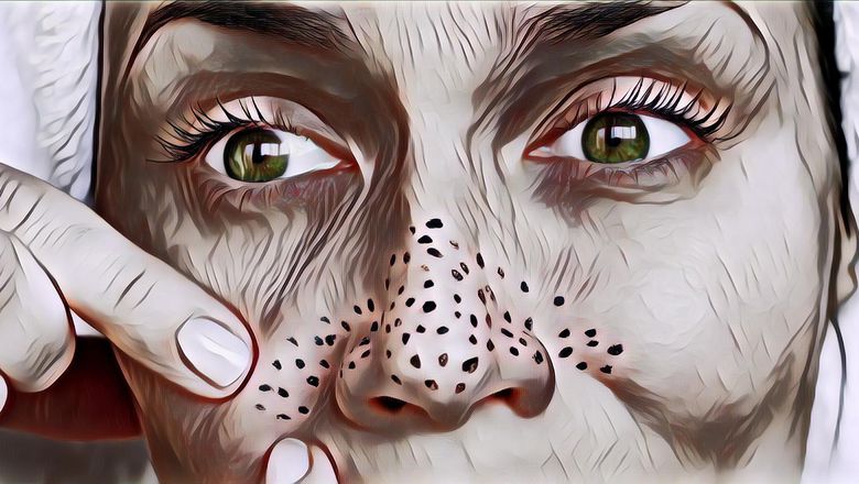 4 Cara Simpel Atasi Komedo di Kulit Wajah Buat Si Super Sibuk