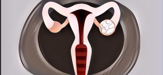 Cara Mengobati Kista: Ini Obatnya yang Mujarab~