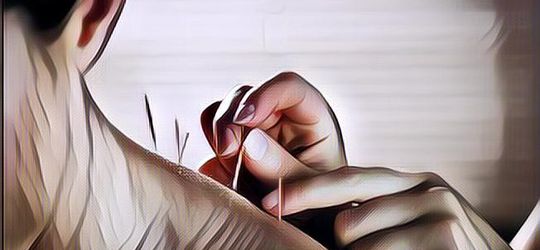 Cara Kerja Akupuntur dan Manfaatnya untuk Kesehatan