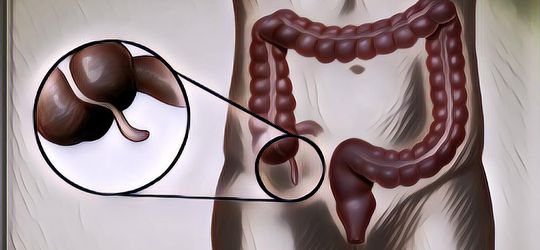 Sebenarnya Apa Penyebab Penyakit Usus Buntu dan Bagaimana Mencegahnya?