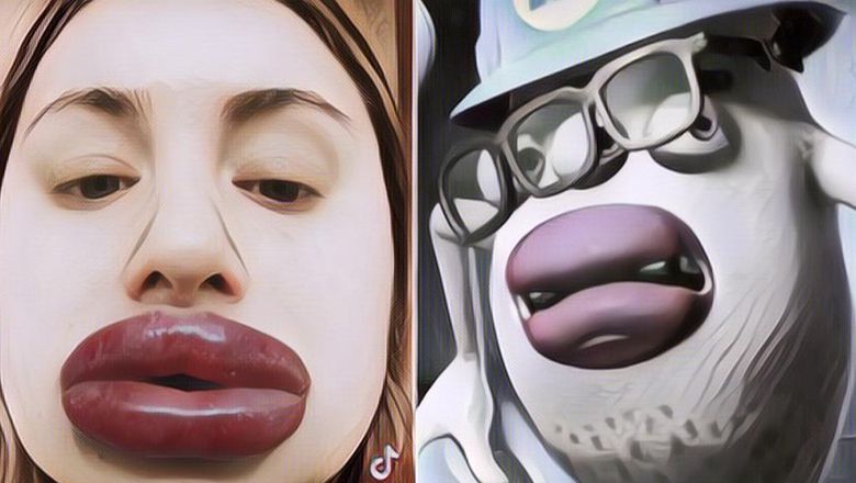 Gara-Gara Alergi Filler, Bibir Wanita Ini Jadi Dower Seperti Karakter di Monster Inc