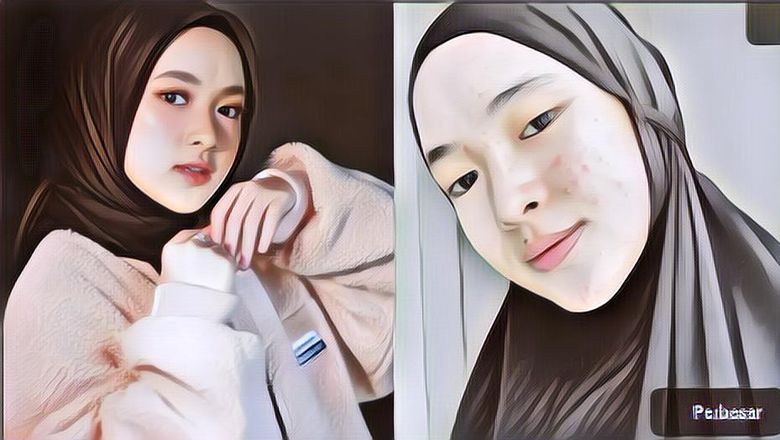 Viral Wajah Nissa Sabyan Diperban Karena Jerawat, Begini Faktanya