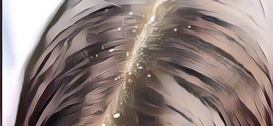 Ini Dia 4 Jenis Ketombe pada Rambut yang Jarang Diketahui