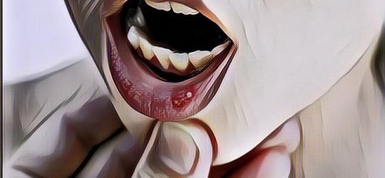 10 Obat Alami yang Bisa Kamu Pakai untuk Menyembuhkan Sariawan