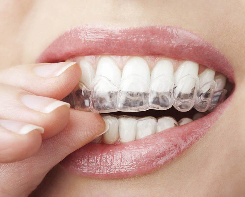 Clear aligner