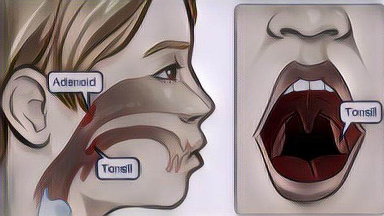 Apakah Adenoid Bisa Sembuh Sendiri?