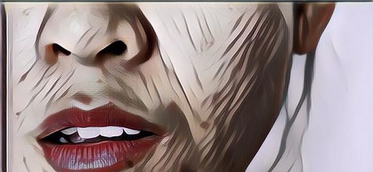 Begini Penjelasan Dokter Soal Penyebab Jerawat di Dagu