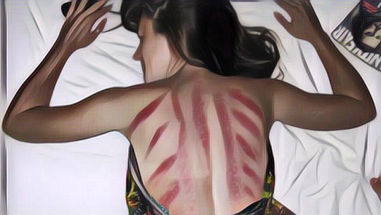 Waduh... Sering Kerokan Bisa Membahayakan Hidupmu, Gengs!