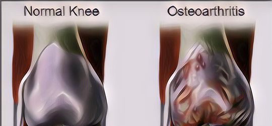 Mengenal Apa Itu Osteoarthritis dan Gejalanya yang Paling Umum