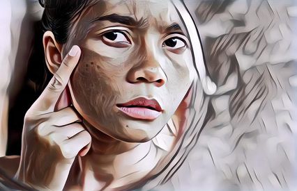 5 Cara Ampuh Agar Flek Hitam di Wajah Memudar
