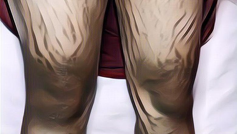 Kulit Rusak Permanen Karena Lotion Abal-Abal, Hati-hati Kalau Beli Produk