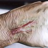 Apa Itu Keloid, Penyebab, dan Cara Menghilangkannya?
