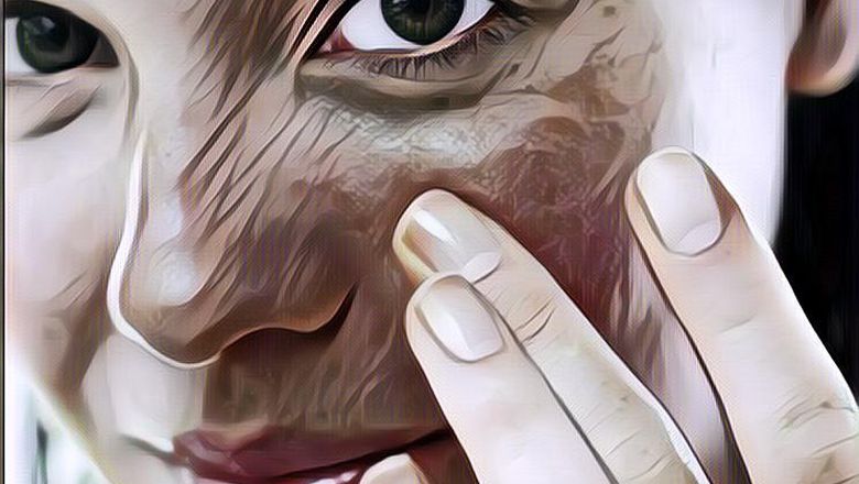 Gak Perlu Biaya Mahal! Ini Dia Tips Menghilangkan Flek Hitam di Wajah dengan Bahan Alami Rumahan