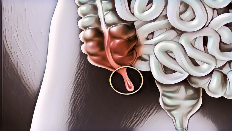 Gejala dan Cara Mencegah Penyakit Usus Buntu, Perhatikan Pola Makan!