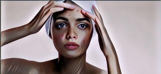 Jangan Dilakukan Lagi, Ternyata Ini Lho 3 Kebiasaan yang Menyebabkan Jerawat Rajin Datang