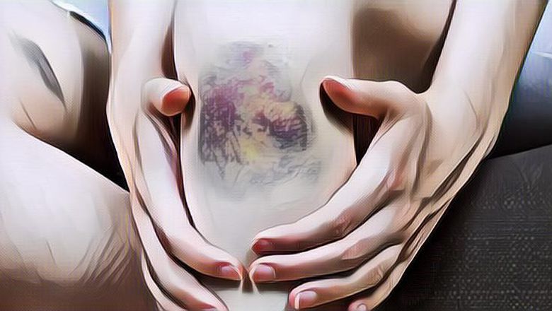 Cara Menghilangkan Bekas Luka dengan Bahan Alami